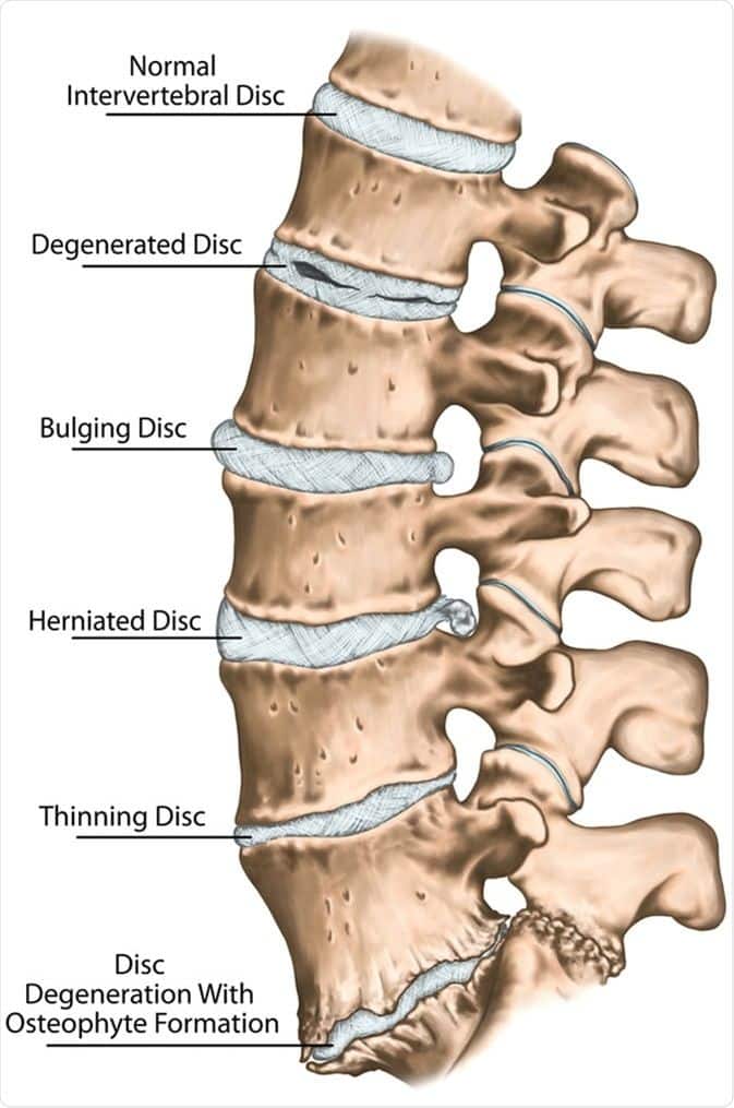 دیسک گردنی | Cervical Disc